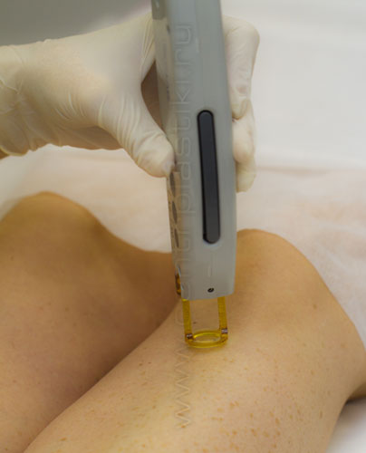 Александритовый лазер для лазерной эпиляции