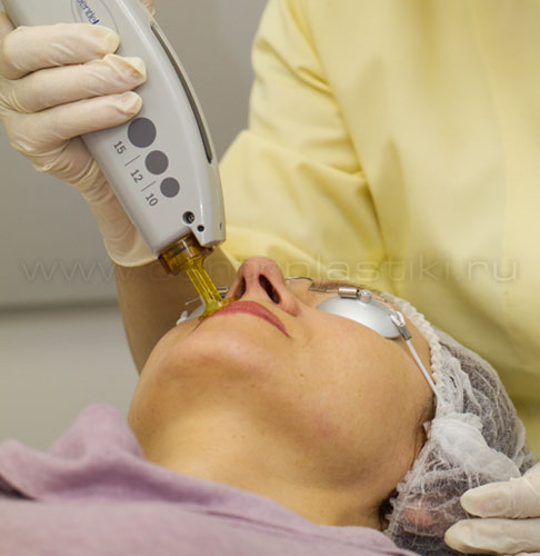 Александритовый лазер для лазерной эпиляции