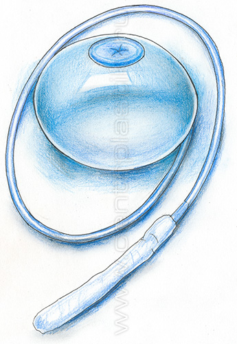 Внутрижелудочный баллон