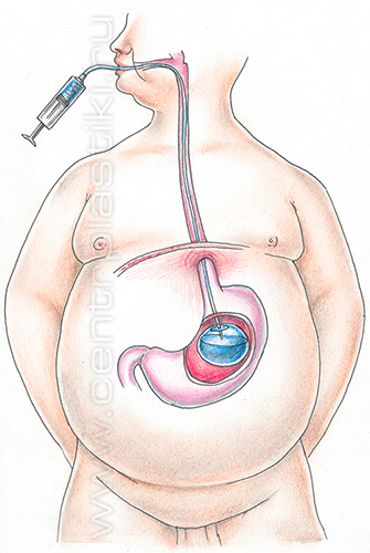 Внутрижелудочный баллон