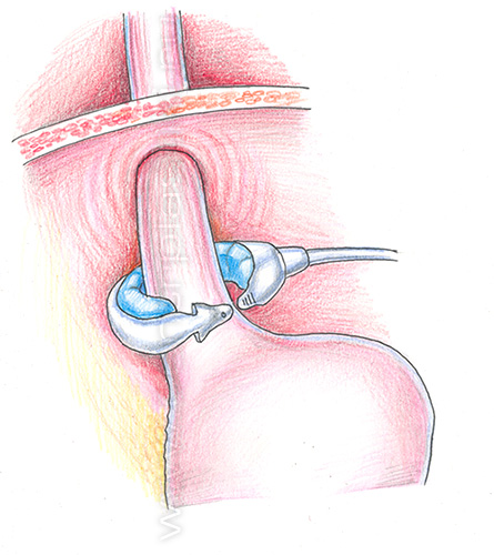 Бандажирование желудка