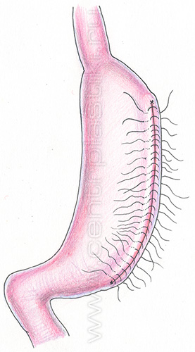 Продольная резекция желудка