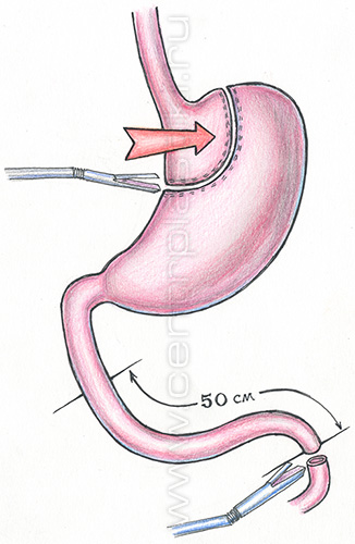 Шунтирование желудка