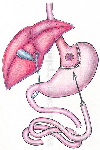 Шунтирование желудка