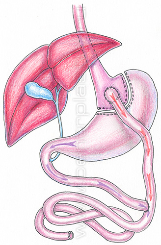 Шунтирование желудка