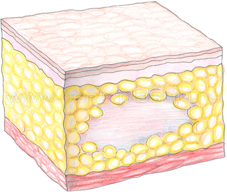 Инъекционный липолиз