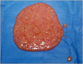 Удаленный жир после операции липосакции