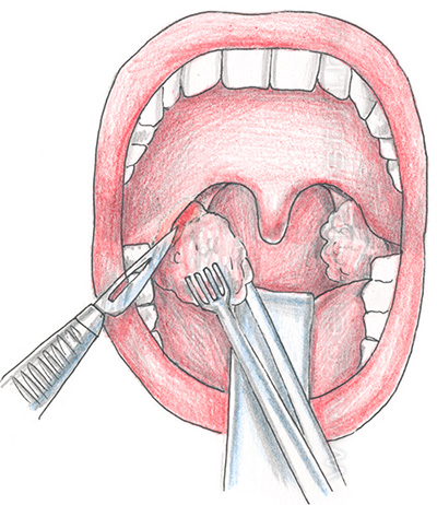 Удаление гланд