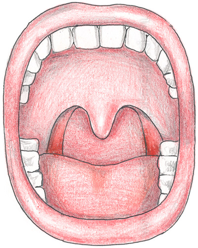 Удаление гланд