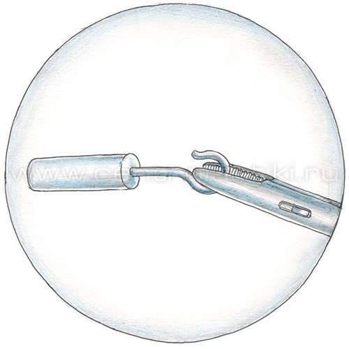 Отосклероз