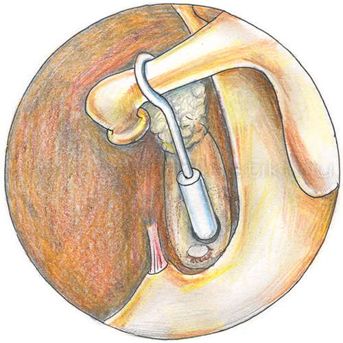 Отосклероз