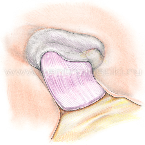 Хронический отит