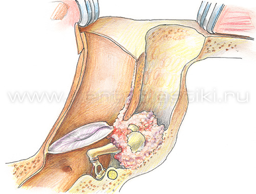 Хронический отит