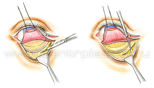 Подтяжка средней зоны лица