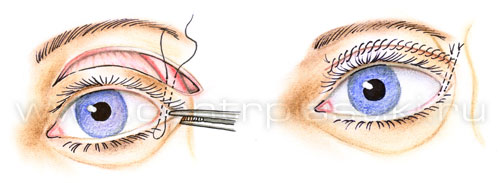 Подтяжка средней зоны лица