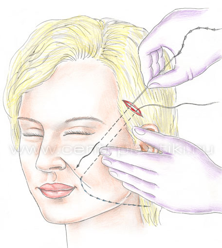 Подтяжка лица нитями