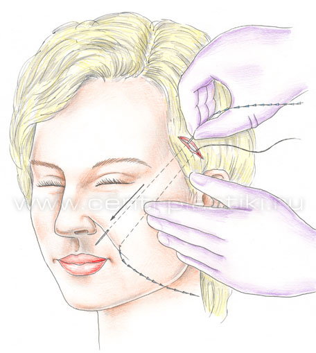 Подтяжка лица нитями