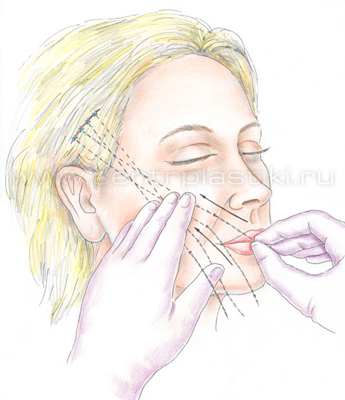 Подтяжка лица нитями