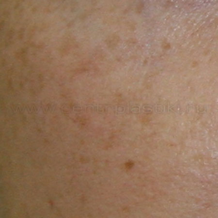 Пигментные пятна