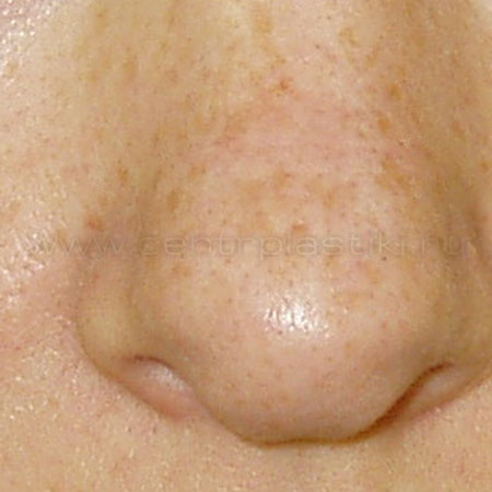 Пигментные пятна