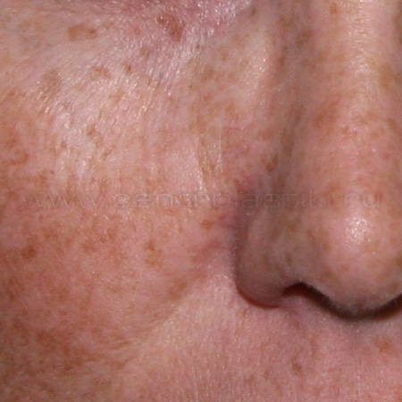 Пигментные пятна