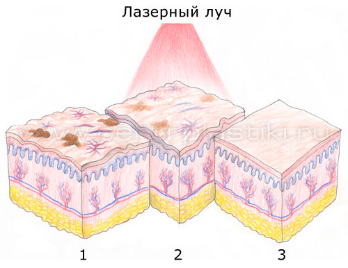 Удаление пигментных пятен лазером