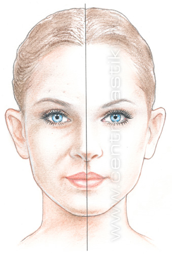 Плазмолифтинг