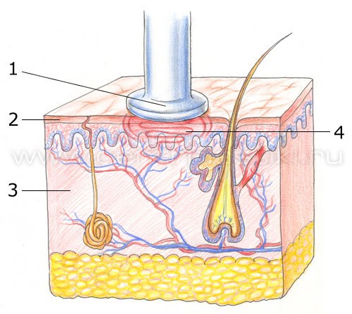Радиочастотный (RF) лифтинг