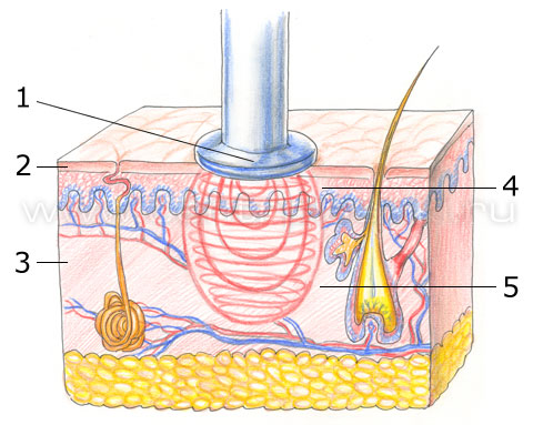 Радиочастотный (RF) лифтинг