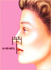 Пластика носа - Форма носа 3