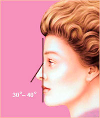 Пластика носа - Форма носа 5