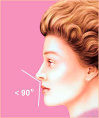 Пластика носа - Форма носа 6