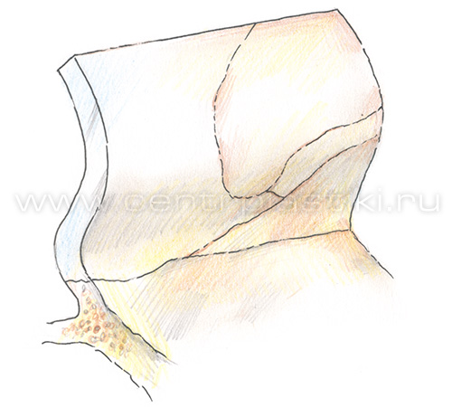 Искривление носовой перегородки