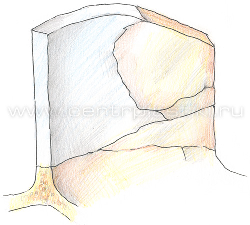 Искривление носовой перегородки