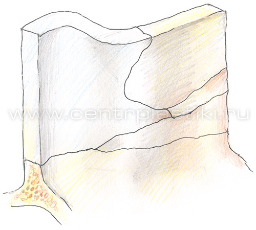 Искривление носовой перегородки