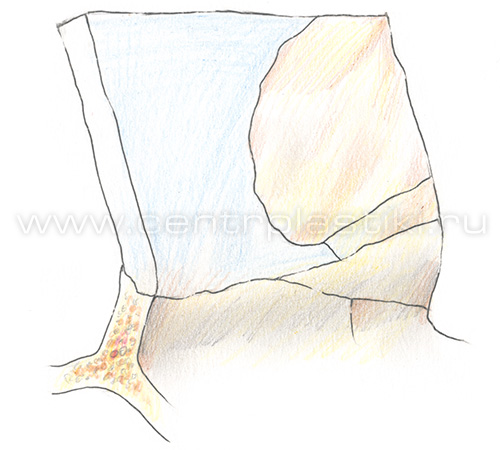Искривление носовой перегородки