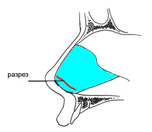 Искривление носовой перегородки