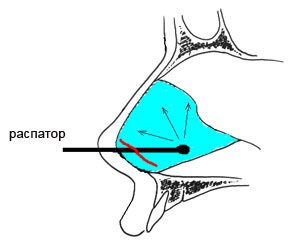 Искривление носовой перегородки