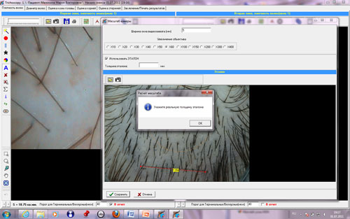 Компьютерная диагностика волос - Трихоскопия