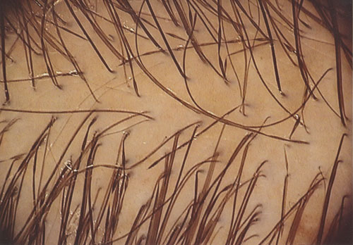 Компьютерная диагностика волос - Трихоскопия