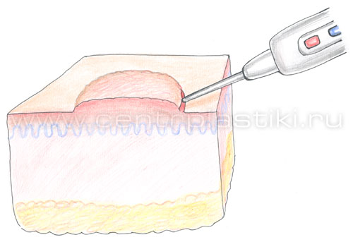 Удаление кератомы