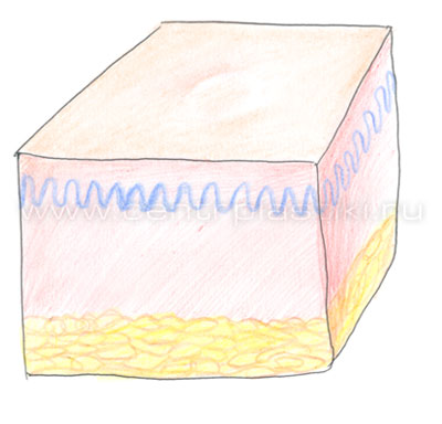 Удаление кератомы
