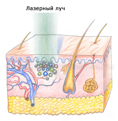 Удаление татуировки лазером