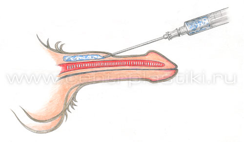 Увеличение полового члена