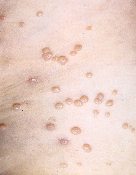 Контагиозный моллюск