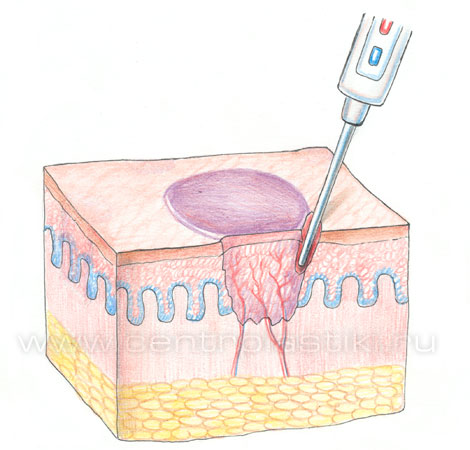 Контагиозный моллюск
