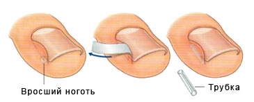 Вросший ноготь