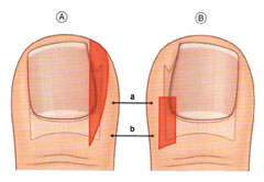 Вросший ноготь