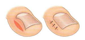 Вросший ноготь