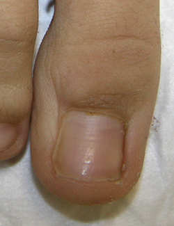 Вросший ноготь - фото после